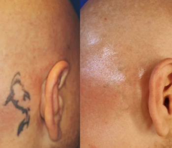 tattoo removal sydney